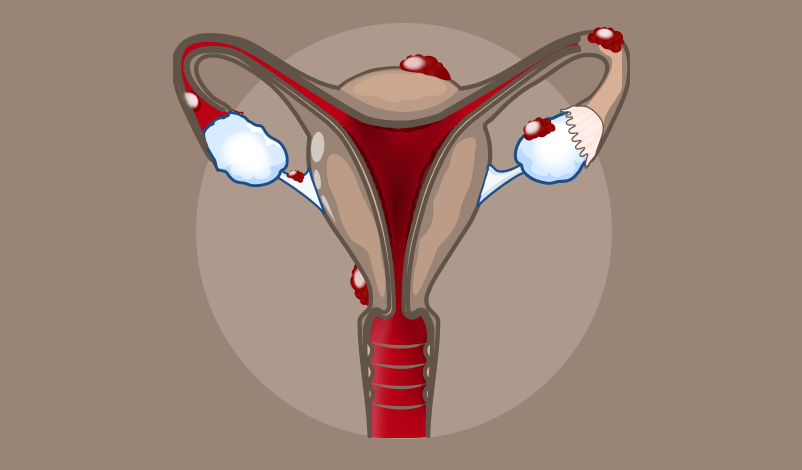 Imgem ilustrativa de um útero doente