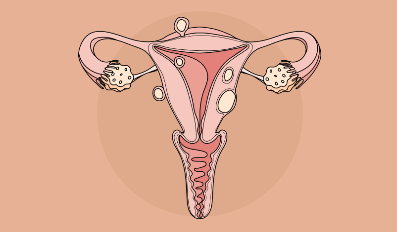 Imagem ilustrativa de um útero com miomas.