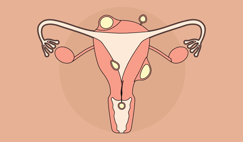 Imagem ilustrativa de um útero com pólipos.
