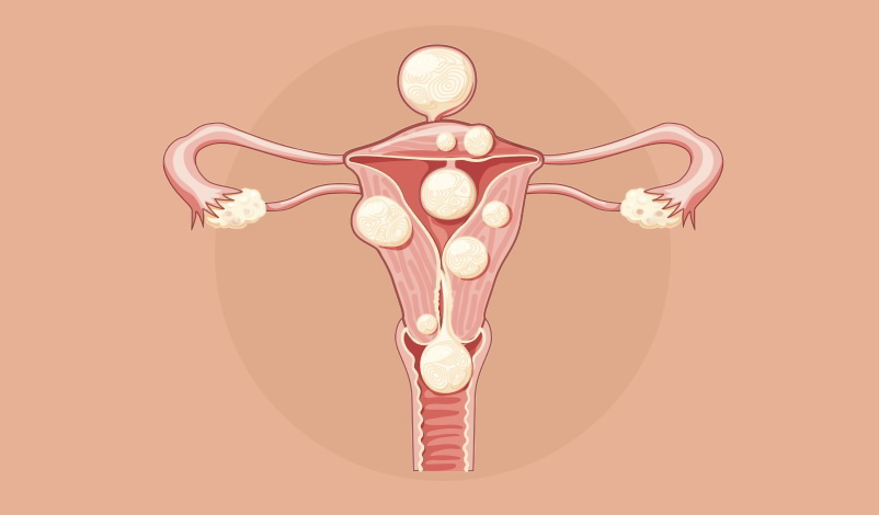 Imagem ilustrativa de um útero doente.